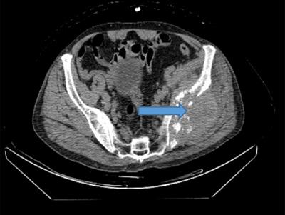 Case Report: A tortuous diagnosis and successful multimodal treatment of thyroid follicular carcinoma with pelvic metastasis